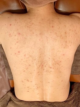 Cocotii 大阪店(ココティー)の写真/グリーンピールボディ背中上部or下部(各A4サイズ)¥33000→¥26400/背中全体(A4サイズ×2)¥66000→¥52800◎