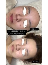 メリアミーゴ(Meli amigo)/20代　人幹細胞ハーブピーリング