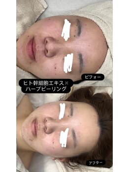 メリアミーゴ(Meli amigo)/20代 人幹細胞ハーブピーリング