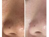 【ニキビケア】皮脂やテカリが気になる方へ！肌荒れ予防の特別フェイシャル