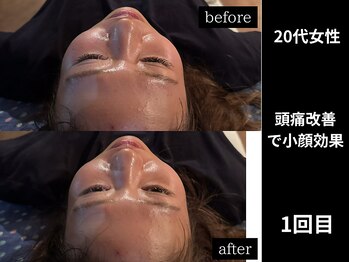 ミーツ(MEETS)/ツラい頭痛改善で小顔に