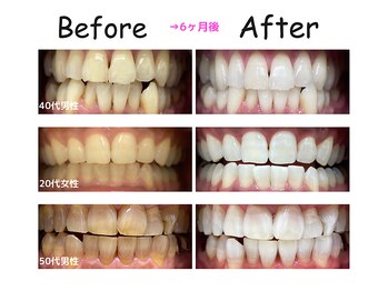 エクシアホワイトニング 日本橋店/みんな白くなりすぎてびっくり