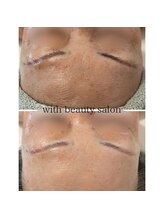 ウィズ(with)/REVIハーブピーリング