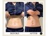 【ぽっこりお腹の改善ダイエット目的の方】腸もみ+電磁パルス痩身　約150分