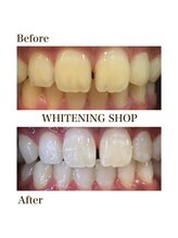 ホワイトニングショップ つくば店(WHITENING SHOP)/ホワイトニングビフォーアフター