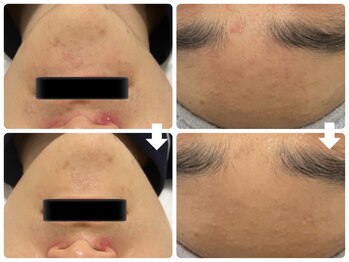 エフェクト 塚口店(effect)/Before After 10代/1回目