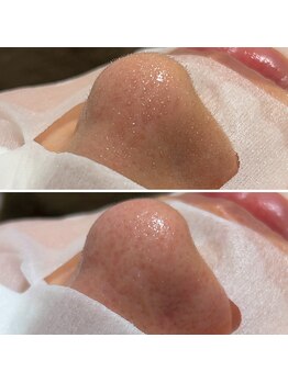 ノーブル 上土店(Noble)/毛穴洗浄BeforeAfter