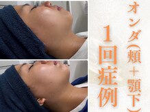大人気♪オンダ施術で二重顎や口元の志望を撃退します