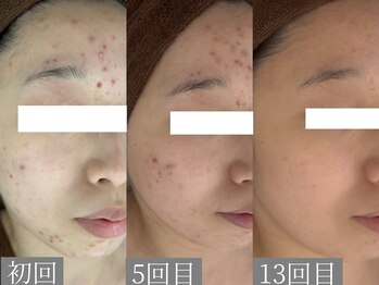 ホワイトアクア 鳳店(WHITE AQUA)/ハーブピーリング/大阪/鳳/毛穴