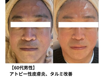 ボニータ(Bonita)/【Lit】ヒト羊膜幹細胞エステ