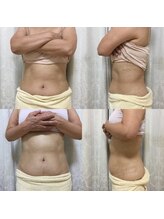 エン ボディアンドフェイシャル(En)/腸セラピー/腸もみ　５回