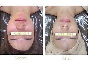 アンジェリーク/メグミ絶賛肌育ハーブピーリング