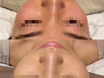 ルース 白河店(LUZ)/赤み・乾燥症例写真