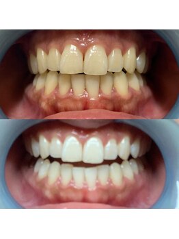 アイネ(i:Ne)/セルフホワイトニング