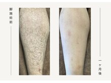 クレビア(CREVIA)/メンズあし脱毛◆BeforeAfter