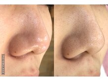 ココ(Coco)/毛穴洗浄・ソフトピーリング