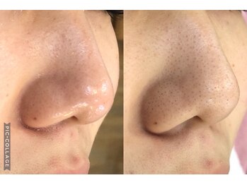 ココ(Coco)/毛穴洗浄・ソフトピーリング