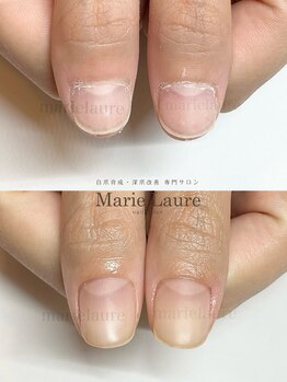 マリーロール 淀屋橋本店(Marie Laure)/自爪育成/深爪矯正/ネイルケア