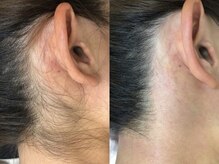 アルゴ 熊本光の森店(ALGO)/【うなじ】WAX人気パーツ第２位