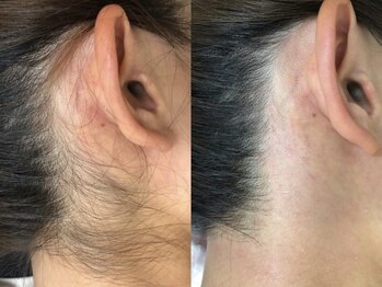 アルゴ 熊本光の森店(ALGO)/【うなじ】WAX人気パーツ第２位