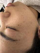 リコリス(Lycoris)/毛穴洗浄