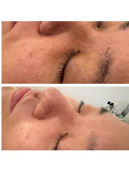 カンフリエ 吉野ヶ里店(Camphrier)/ハーブピーリング