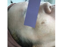 エスティフル 狭山店(ESTIFUL)/Before/フェイシャル/マッサージ