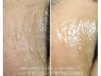 ストーリー 沼津店(STORY)/ハーブピーリング専門店STORY