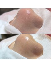 ノーブル 上土店(Noble)/毛穴洗浄BeforeAfter