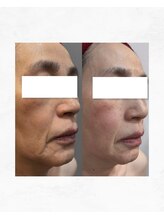 アルル 甲賀(ARuru)/透輝肌エステ2回でこの効果！