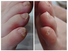 アンティ(Aunty)/副爪ケア前