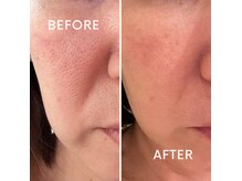 ステージ(Stage)の雰囲気（高周波ケア）