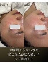 リヴィア(LIVIA)/赤み、シミも