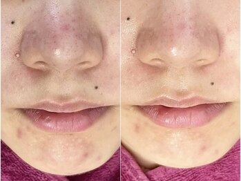 バタフライ 津田沼店(Butterfly)/Butterflyのハーブピーリング