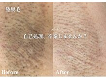 フジモトサロン 那覇おもろまち店(fujimotoサロン)/脇脱毛/全身脱毛