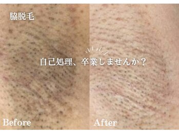 フジモトサロン 那覇おもろまち店(fujimotoサロン)/脇脱毛/全身脱毛