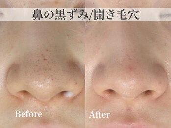 テンニック(10nick)の写真/【黒ずみ・開き毛穴・ザラつき対策に】当日メイクOK/剥離なしのハーブピーリングでツルすべ肌へ。