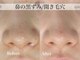 テンニック(10nick)の写真/【黒ずみ・開き毛穴・ザラつき対策に】当日メイクOK/剥離なしのハーブピーリングでツルすべ肌へ。
