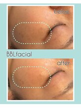 グラント(grant)/【BBL】ビフォーアフター