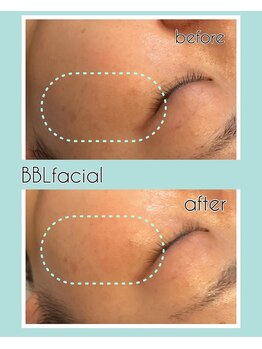 グラント(grant)/【BBL】ビフォーアフター