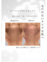 プロラボスパ 姫路店/つるつる毛穴