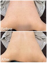 サロンドフェイス(Salon de Faith)/背中ハーブピーリング5回