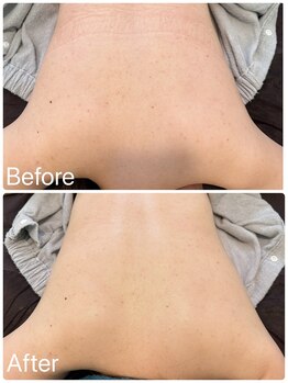 サロンドフェイス(Salon de Faith)/背中ハーブピーリング5回