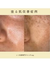 ピーナップ(P-nap)/シミ改善６０代