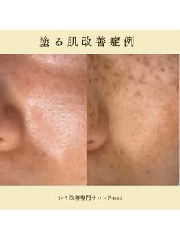 ピーナップ(P-nap)/シミ改善60代