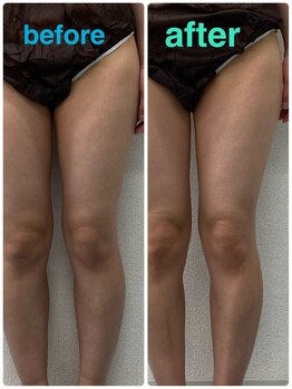 ハロ 南青山(HALO)/全身ラジオ波痩身