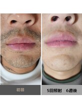 キムラケ 和光別邸(木村家 KIMURAKE)/メンズ脱毛ヒゲビフォーアフター