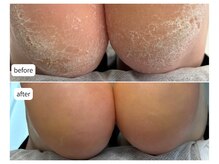 カシェット(Cachette)/40代女性◎足裏角質ケア90分