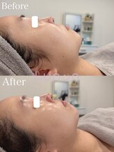 ルノン(Lunon)/毛穴洗浄ハイドロ×ララピール