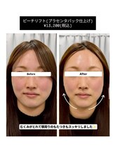 クレール 小山店(CLAIR)/【二重あご・むくみ改善】